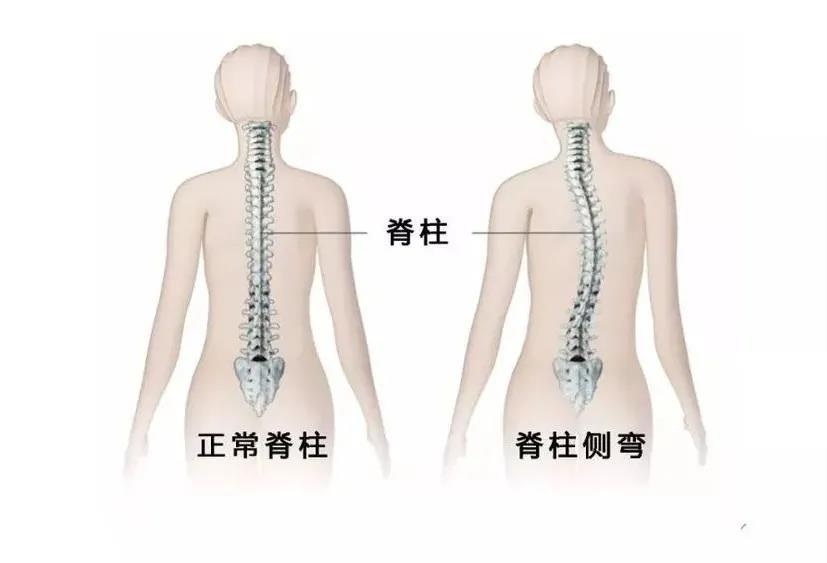 脊柱弯曲怎么办？（二）
